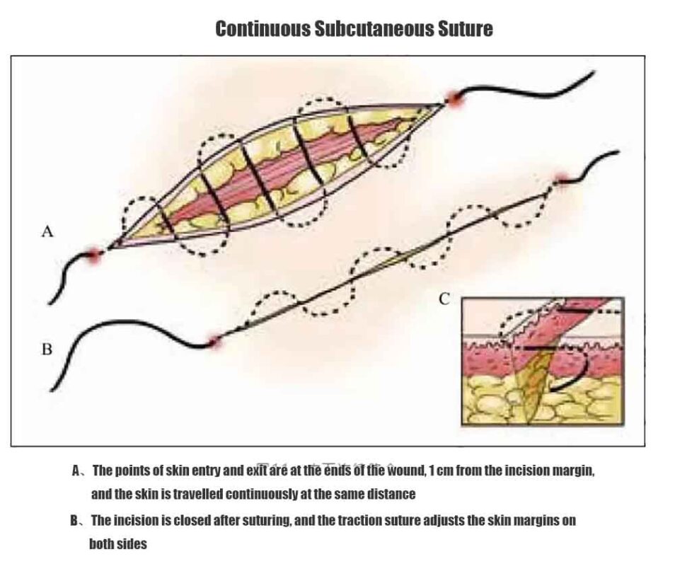 A Comprehensive Guide To Surgical Suturing Techniques